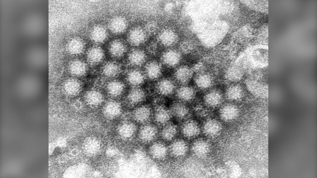 This electron microscope image provided by the Centers for Disease Control and Prevention shows a cluster of norovirus virions. (THE CANADIAN PRESS/AP-HO, CDC, Charles D. Humphrey,)